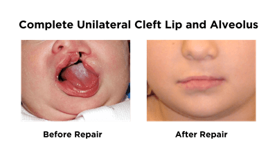 Complete Unilateral Lip and Alveolus