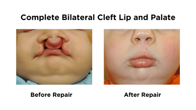 Complete Bilateral Cleft Lip and Palate