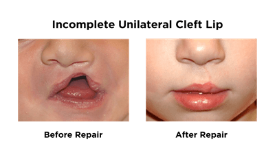 Incomplete Unilateral Cleft Lip