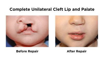 Complete Unilateral Cleft Lip and Palate