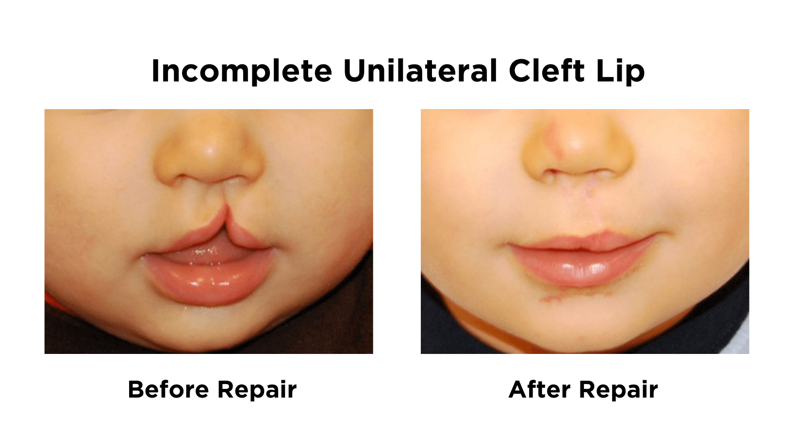 Incomplete Unilateral Cleft Lip