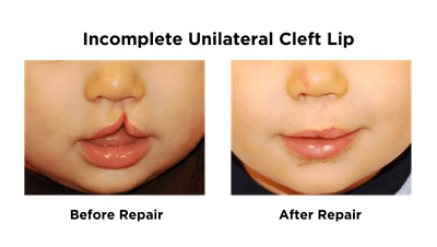 Incomplete Unilateral Cleft Lip