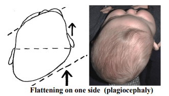 Flattening on One Side (plagiocephaly)
