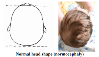 Normal Head Shape (normocephaly)