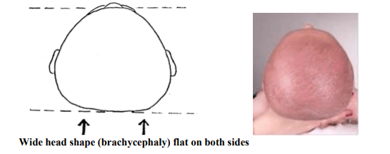Wide Head Shape (brachycephaly) flat on both sides