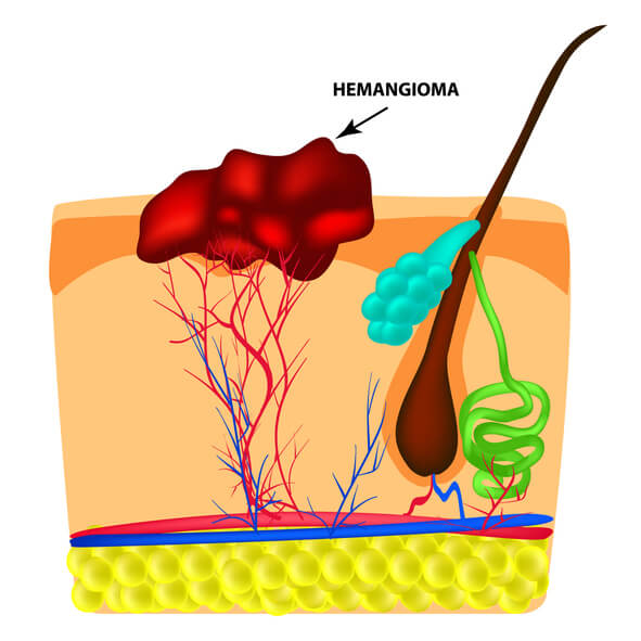 Structure Hemangeoma. The structure of the red mole on the skin, Birthmark.