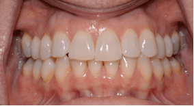 Adult care centerline deviation right canine substitution