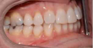 Adult care centerline deviation right canine substitution