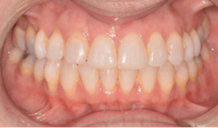 Adult care centerline deviation right canine substitution