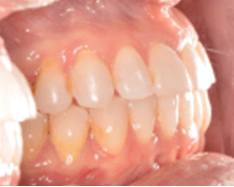 Adult care centerline deviation right canine substitution