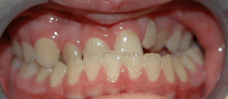 Teeth before braces and jaw surgery