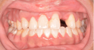 Implant planned for missing lateral incisor