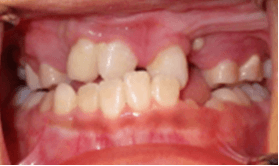 Unilateral cleft lip and palate