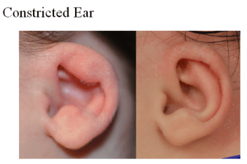 Constricted Ear