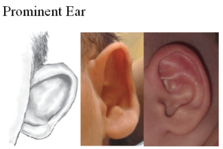 Prominent Ear