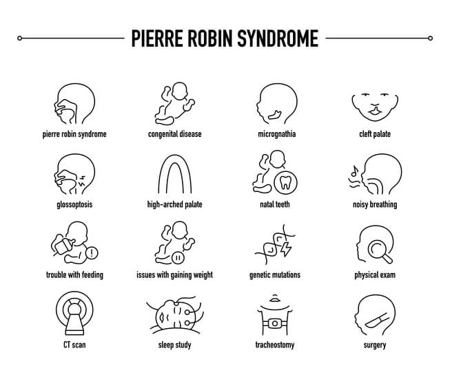 Pierre Robin Syndrome symptoms, diagnostic and treatment vector icon set