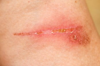 Scar Signs of Infection