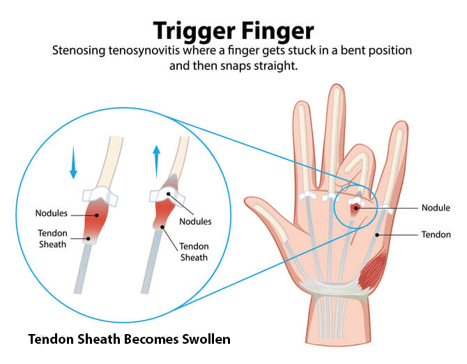 Diagram explaining trigger finger condition