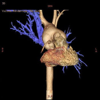 3D CT Image of Aorta and Hypoplastic Left Heart Syndrome