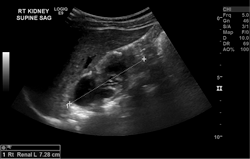 Hydronephrosis Ultrasound