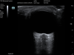 Ophthalmology Ultrasound