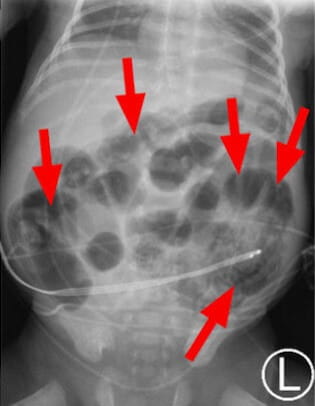 X-ray of necrotizing enterocolitis (NEC