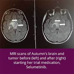 Autumn Paolini's MRI scans