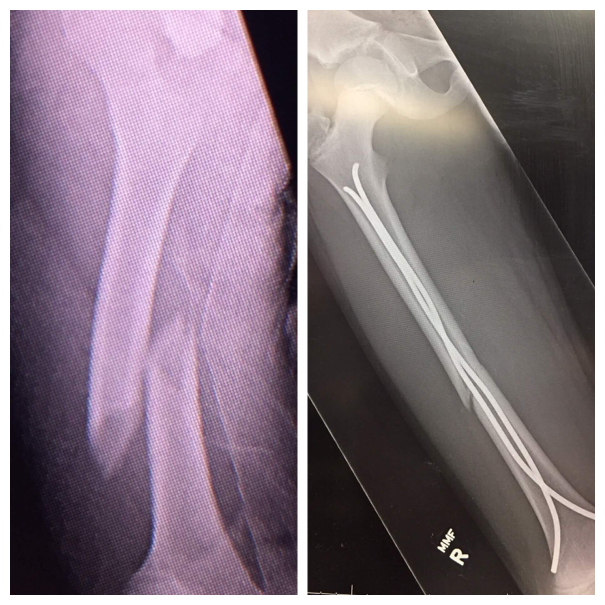 Zach's x-ray of his broken leg