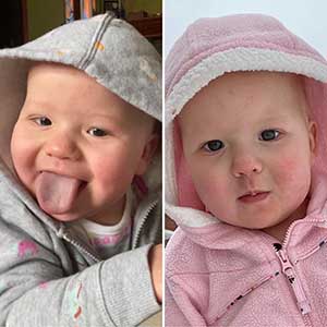Brynlee Lee before and after tongue reduction surgery