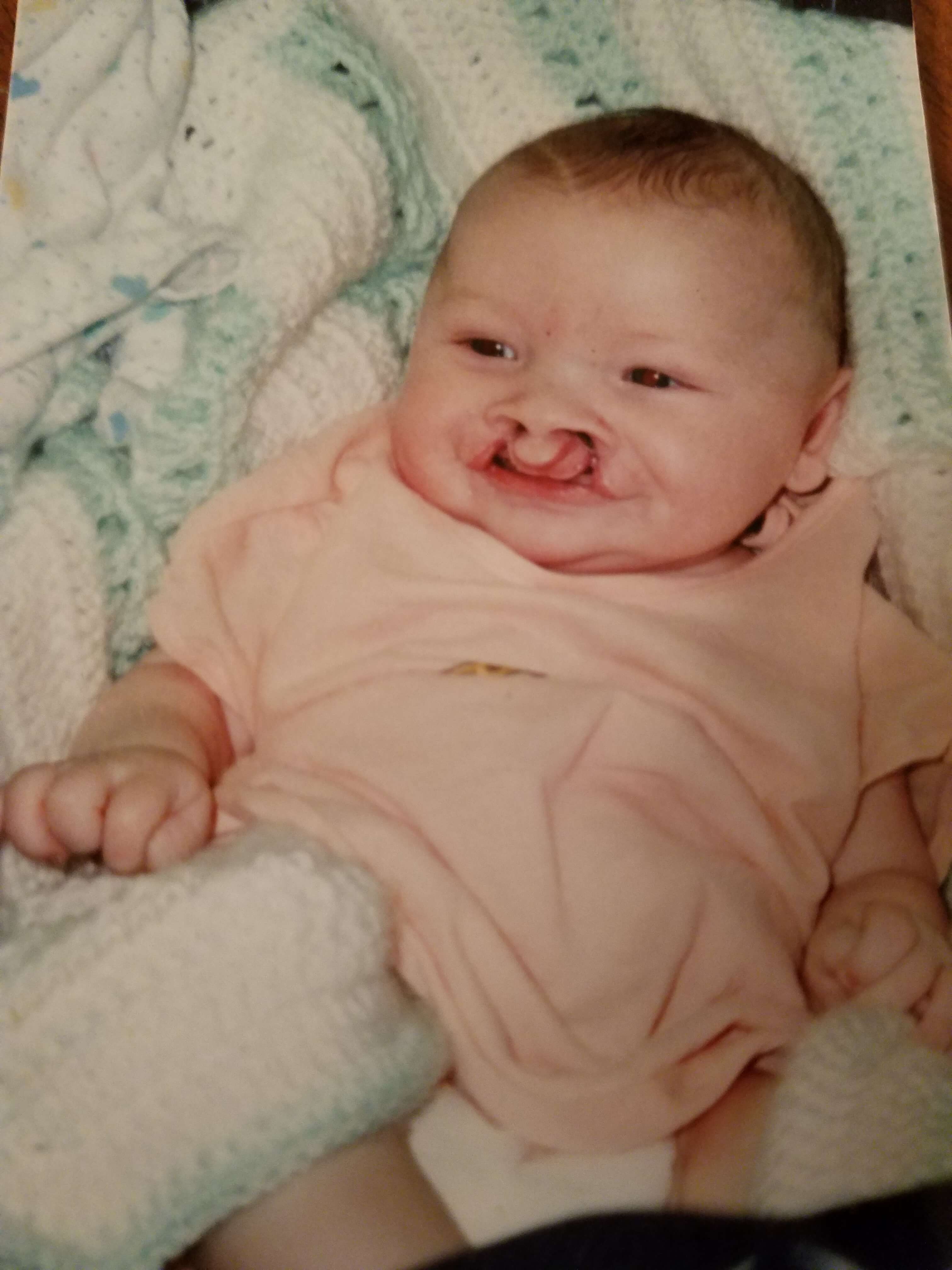 Ryan as an infant, wearing a pink onesie. He was born with a complete clef lip and palate.