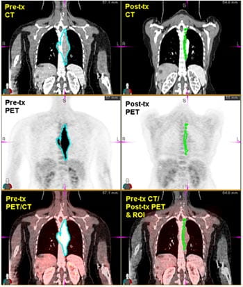 SUV threshold defined region of interest precisely translated to CT imaging at both baseline and therapy response.