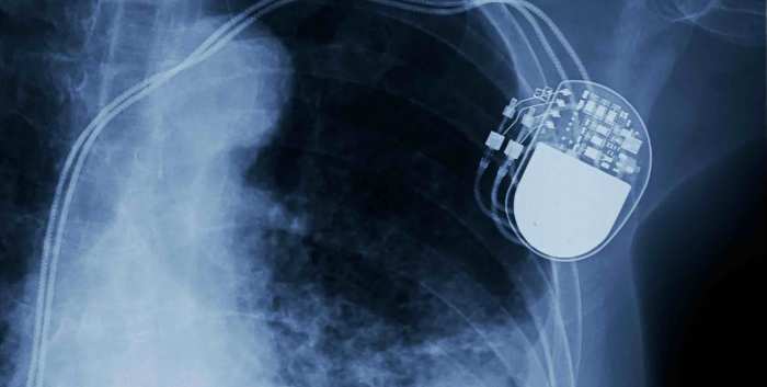 Advanced Heart Failure and VADs in the Community