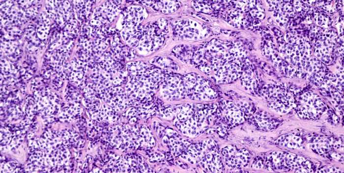 betaCatenin Hepatocellular Cancer From Bench to Bedside