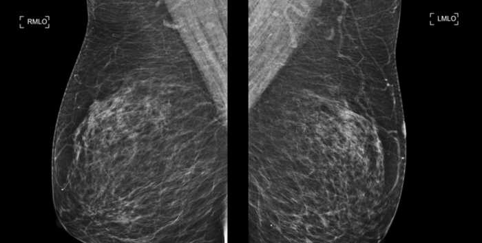 ContrastEnhanced Mammography