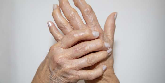 Cytokine Storms in our Backyards Autoinflammation for the General Rheumatologist