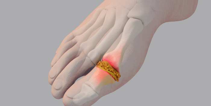 More Than a Nuisance Arthritis Gouts Effects on the Cardiovascular System