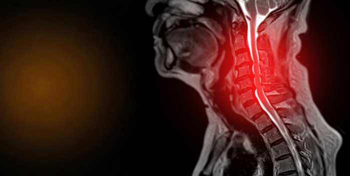 Myelopathy Through a Surgeons Lens