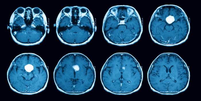 Racial and Socioeconomic Disparities in Patients with Meningioma