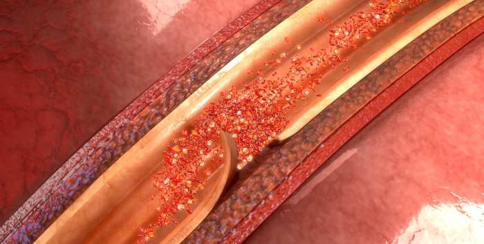 Spontaneous Coronary Artery Dissection SCAD