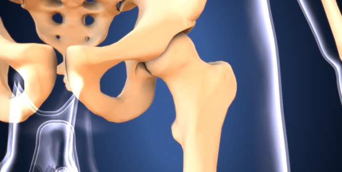 The Hypermobile Hip Biomechanics Diagnosis and Treatment Decision Making Part 2