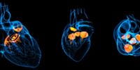 Transcatheter Pulmonary Valve Replacement in Congenital Heart Disease