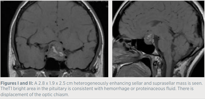 A 2.8 x 1.9 x 2.5 cm heterogeneously enhancing sellar and suprasellar mass is seen. TheT1 bright area in the pituitary is consistent with hemorrhage or proteinaceous fluid. 