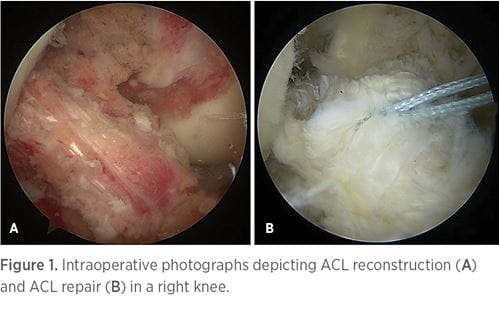 Intraoperative photographs depicting ACL reconstruction and ACL repair