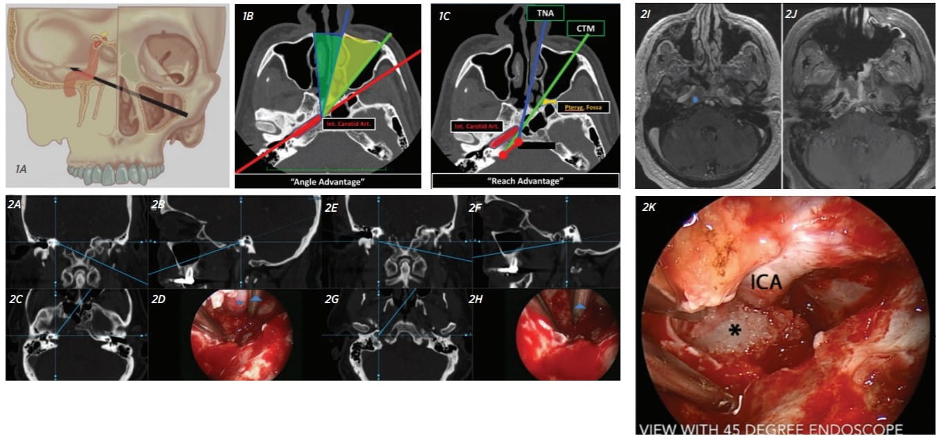 Skull base surgery examples