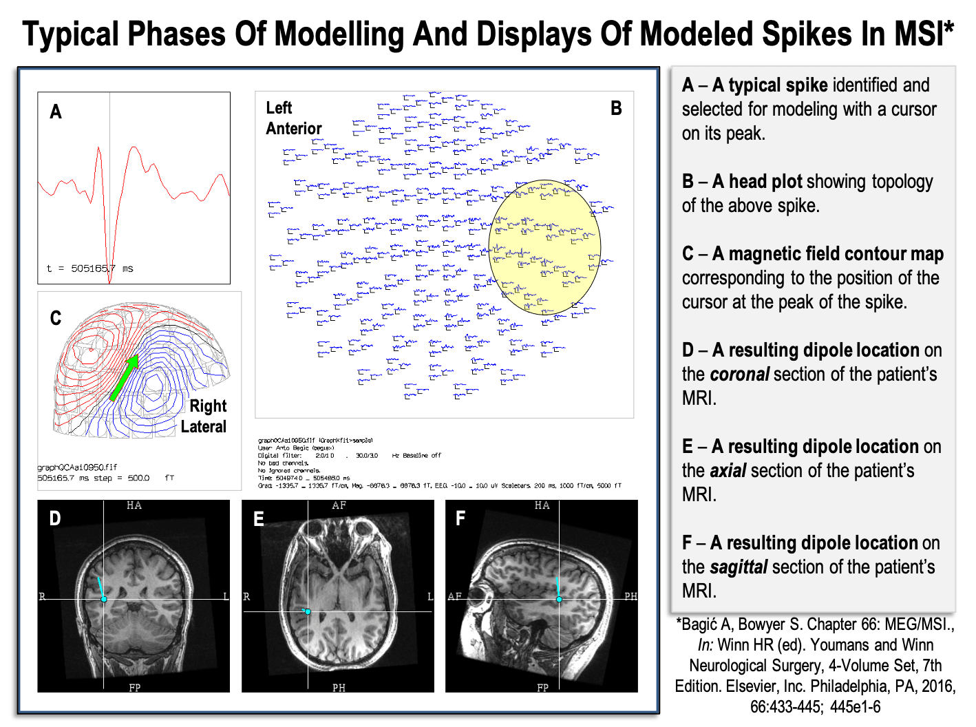 Typical phases of modeling and displays of modeled spikes in Magnetic Source Imaging