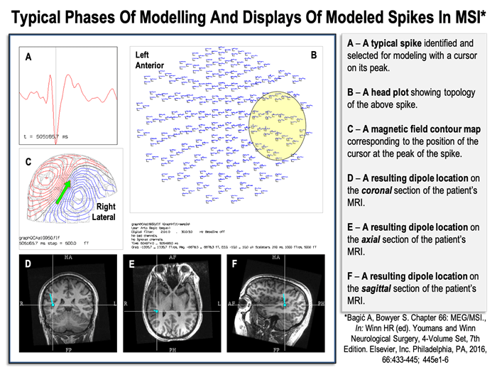 Typical phases of modeling and displays of modeled spikes in Magnetic Source Imaging
