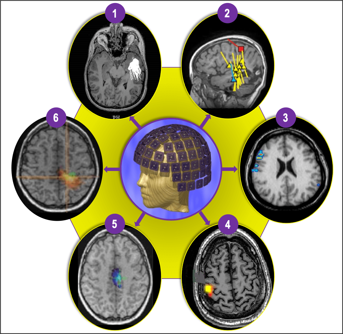 magnetic source imaging 