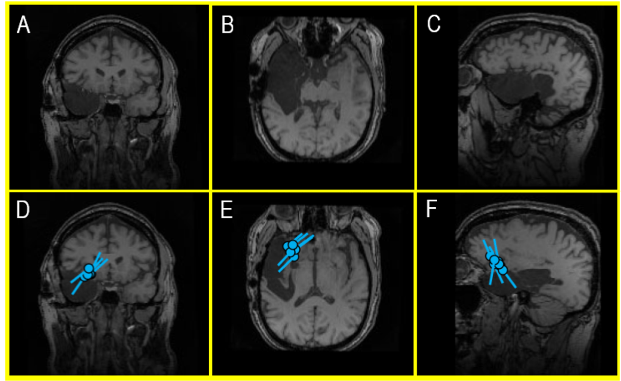 An MRI of a recent external MEG referral patient 