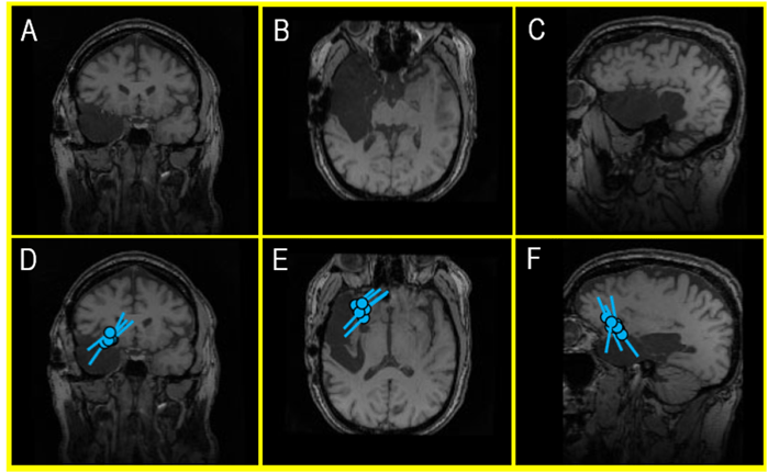 An MRI of a recent external MEG referral patient 