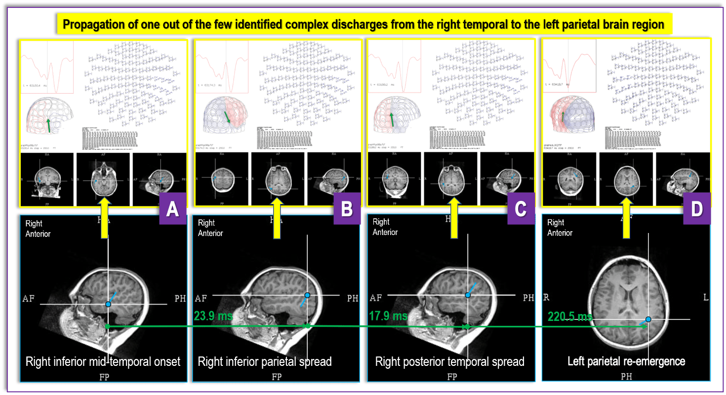 findings from a recent DRE MEG referral from UPMC Children’s Hospital of Pittsburgh for a case with “generalized” and “multifocal” EEG findings